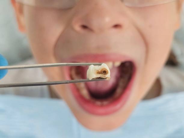 Best Emergency Tooth Extraction in Mount Olive, MS